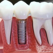 Имплантация зубов - Стоматология в Челябинске | Цены в клинике Стоматологическая здравница