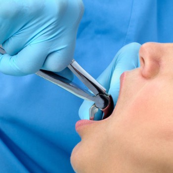Сложное удаление зубов - Стоматология в Челябинске | Цены в клинике Стоматологическая здравница